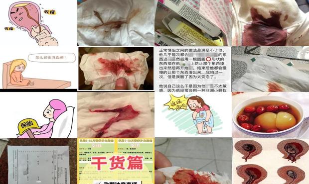 汕头孕期40天流产怎么处理