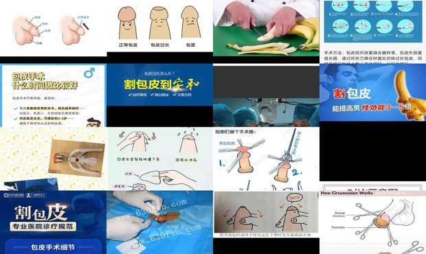 汕头五院妇产医院割包皮怎么样呢