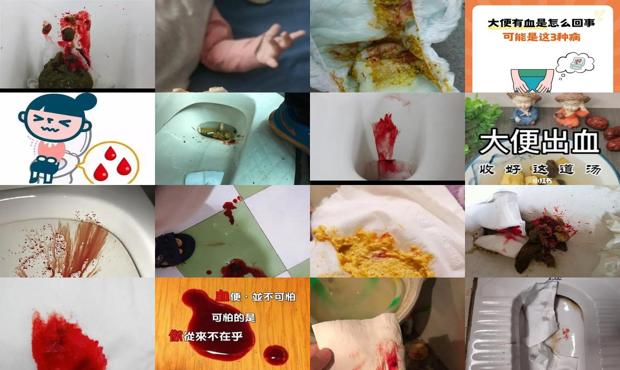 汕头坐月子大便出血怎么办