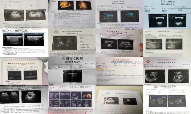 汕头孕检超声检查报告