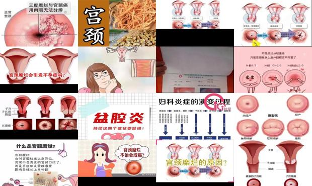 汕头宫颈糜烂 不孕不育