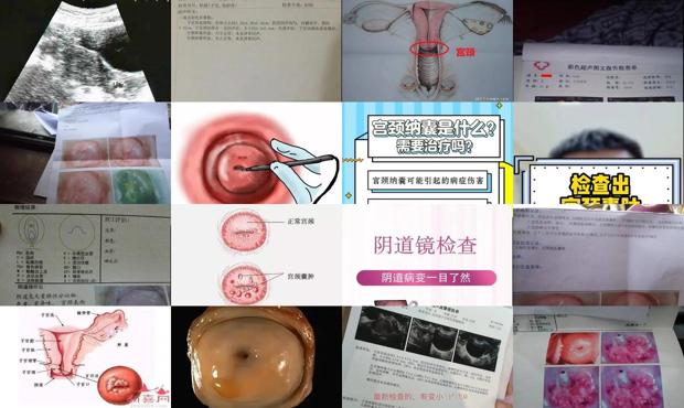 汕头如何检查宫颈有*严重吗