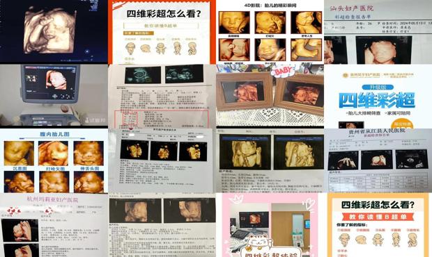 汕头整个孕期做几次四维彩超
