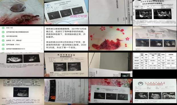 汕头双胎*易流产的月份