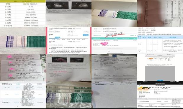 汕头自然流产的血hcg值下降