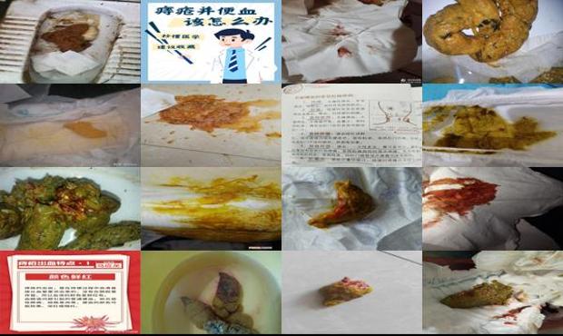 汕头月子里大便干燥出血