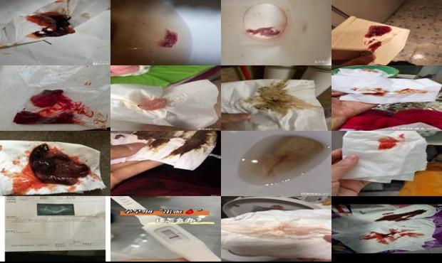 汕头怀孕一个月子宫出血